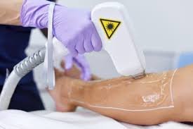 Laser Hair Removal Burns
