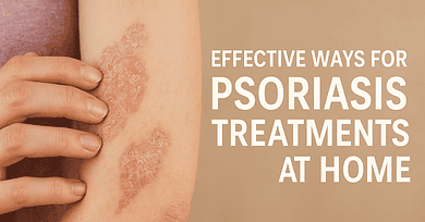 Effective Ways for Psoriasis Treatments at Home